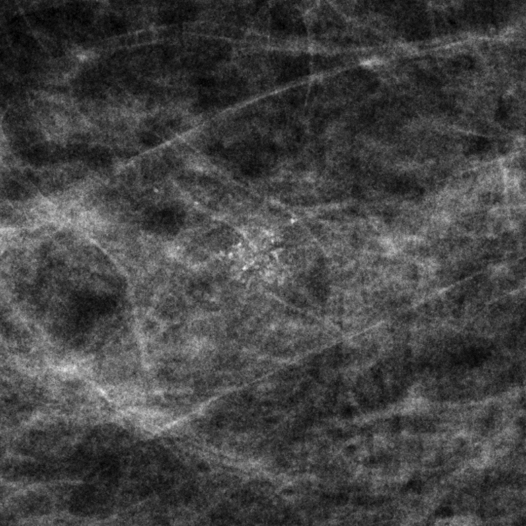 Mammography image showing subtle group of amorphous calcifications